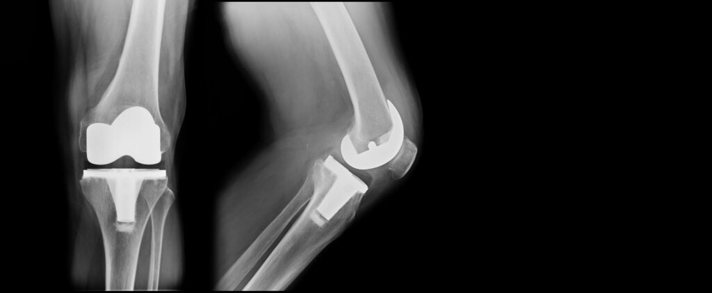 prótesis de rodilla radiografía cirugía articular